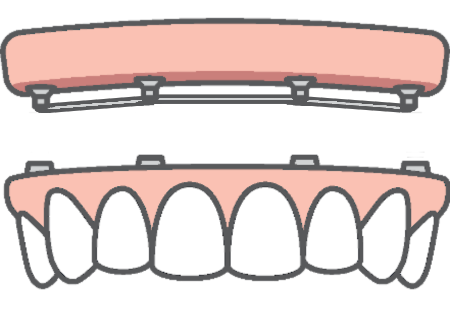 all-on-4 dental implants bar retained