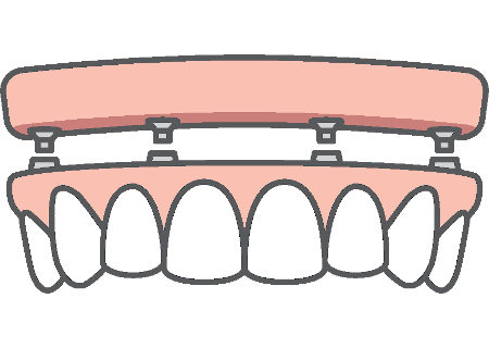 Full jaw restoration with all on 4 dental implants