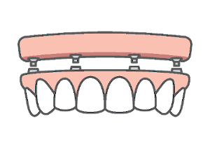 Full jaw restoration with all on 4 dental implants