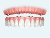 What are dental implants: All on 4 Dental Implant Denture