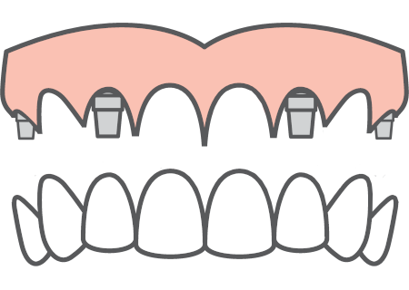 all on 4 zirconium bridge