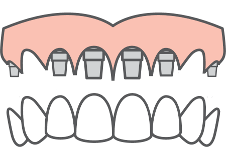 all on 6 zirconium bridge