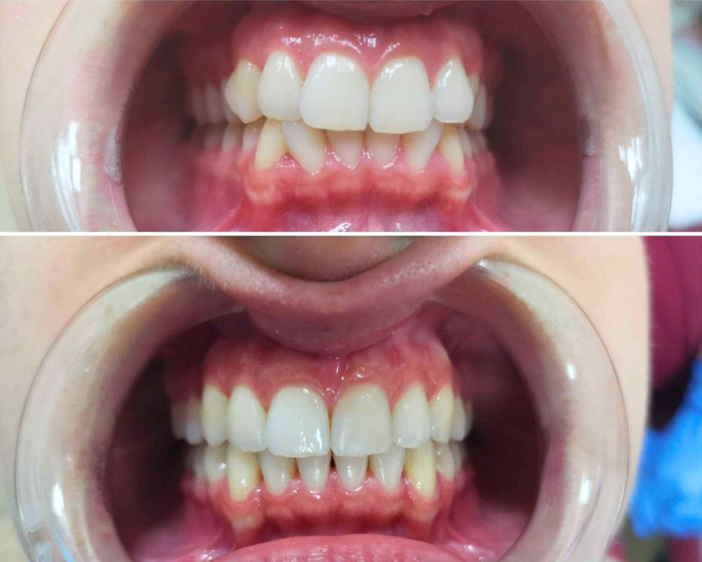 clear aligners before and after