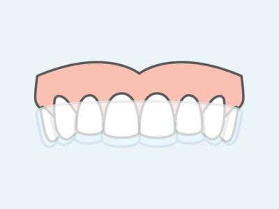 clear aligners