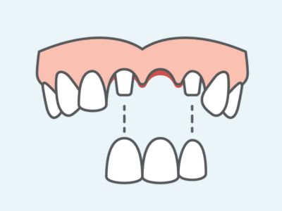 dental bridge