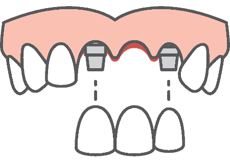 dental implant supported bridge