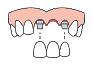 dental implant supported bridge
