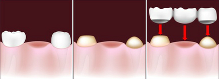 Dental bridge placement