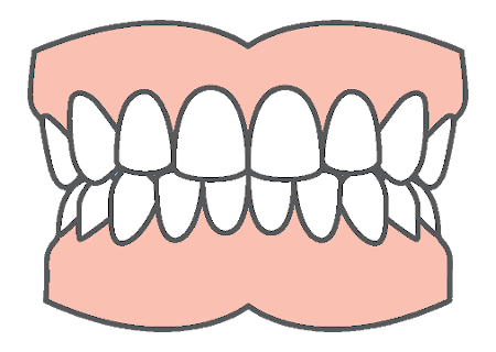 Full mouth restoration with dental implants