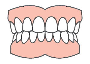Full mouth restoration with dental implants