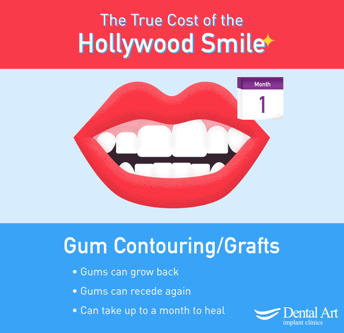 Gum Contouring/Grafts Poster. Gums can grow back. Gums can recede again. Can take up a month to heal. 
