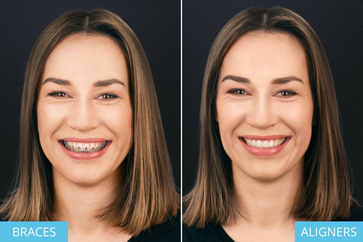 braces vs clear aligners