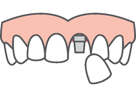 Single Dental Implant