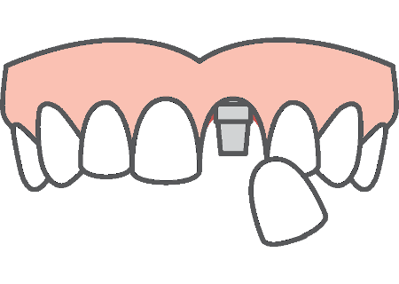 single dental implant