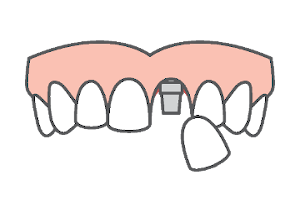 Single Dental Implant