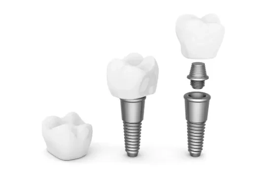 A dental crown, a dental implant and a dental implant split into 3 parts - crown, abutment and titanium screw. 