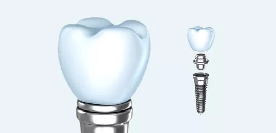 Dental implant close up and a dental implant divided into 3 parts - crown, abutment and titanium screw