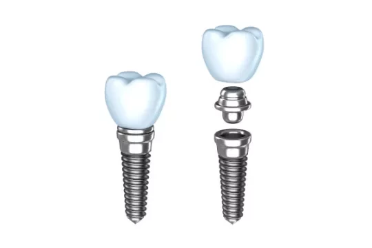 A dental implant and a dental implant split into 3 parts - crown, abutment and titanium screw. 