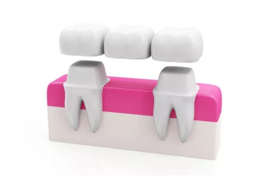A dental bridge