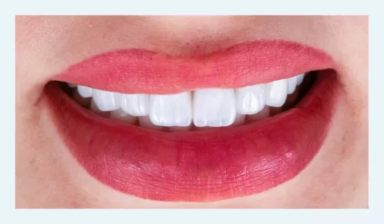 Patient's smile after veneer treatment. 