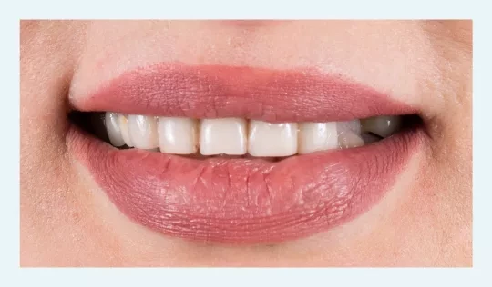 Patient's smile before veneer treatment. 