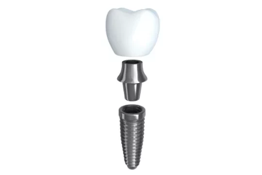 3 parts of a dental implant - crown, abutment and titanium screw