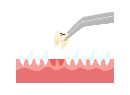 tooth_extractions