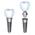 Multiple Dental Implant placement