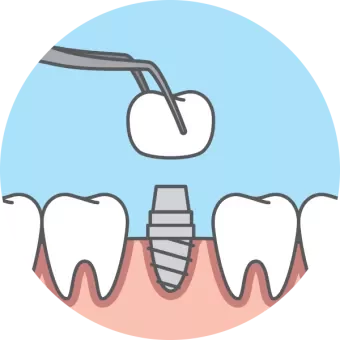 dental implant